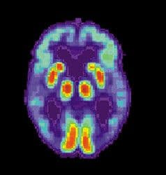 https://cdn.gdch.de/prod/csm_572px_PET_Alzheimer_ebd71ab2ad_e83c575daf.jpg